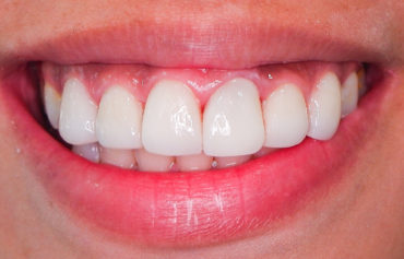 Composite Veneers