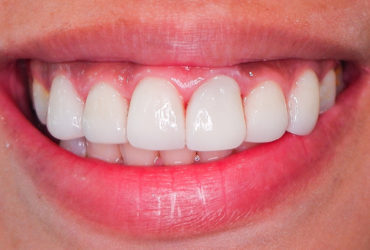 Composite Veneers