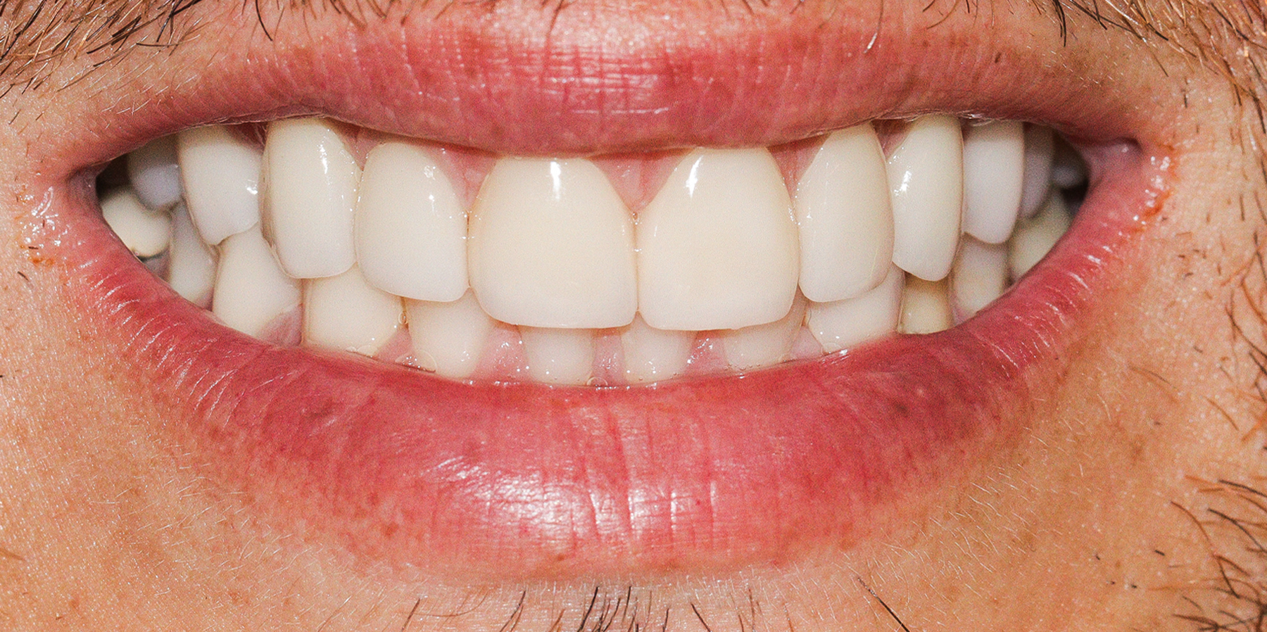 03-Porcelain-Veneers-Slavi-after