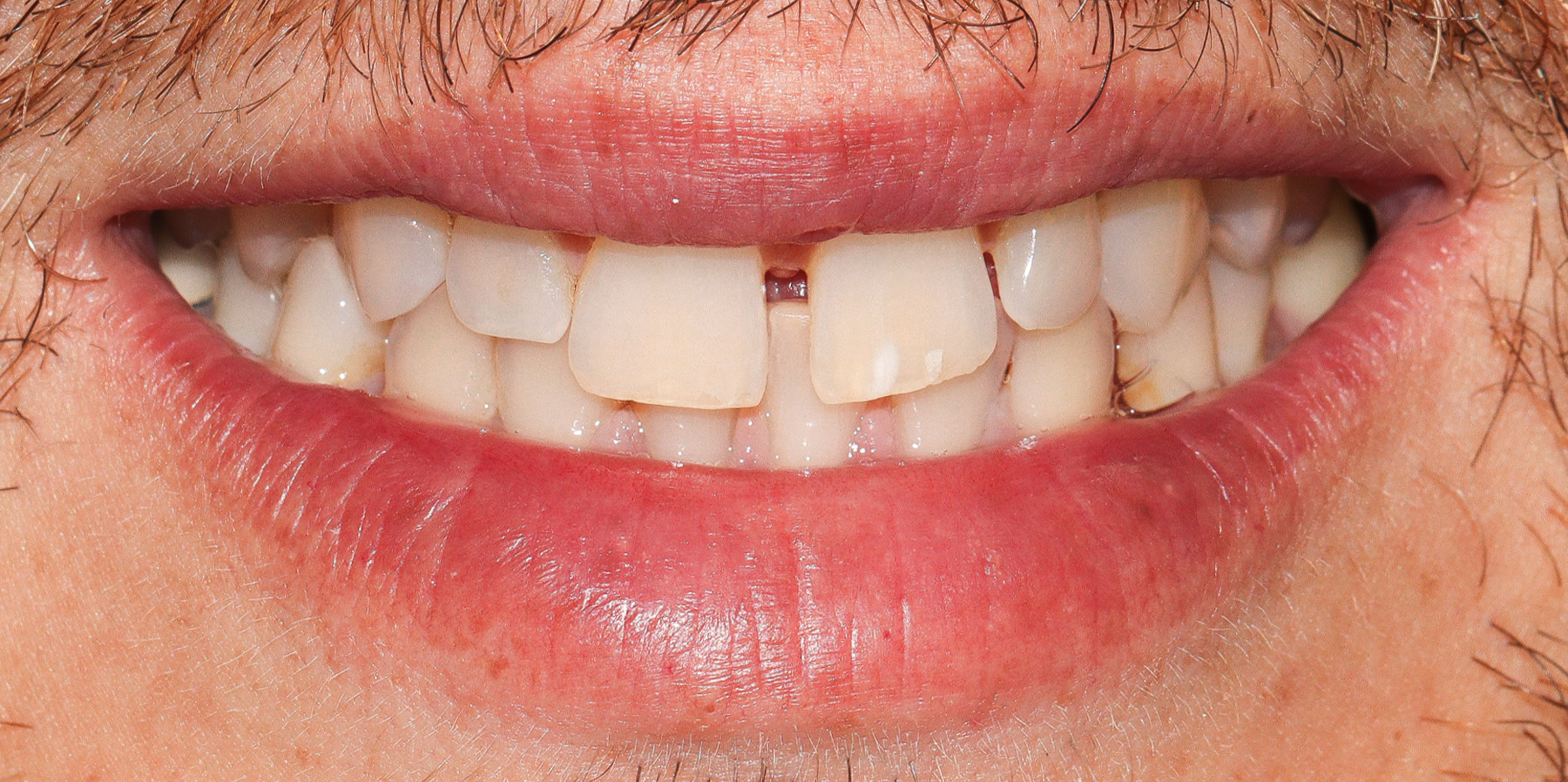 03-Porcelain-Veneers-Slavi-before