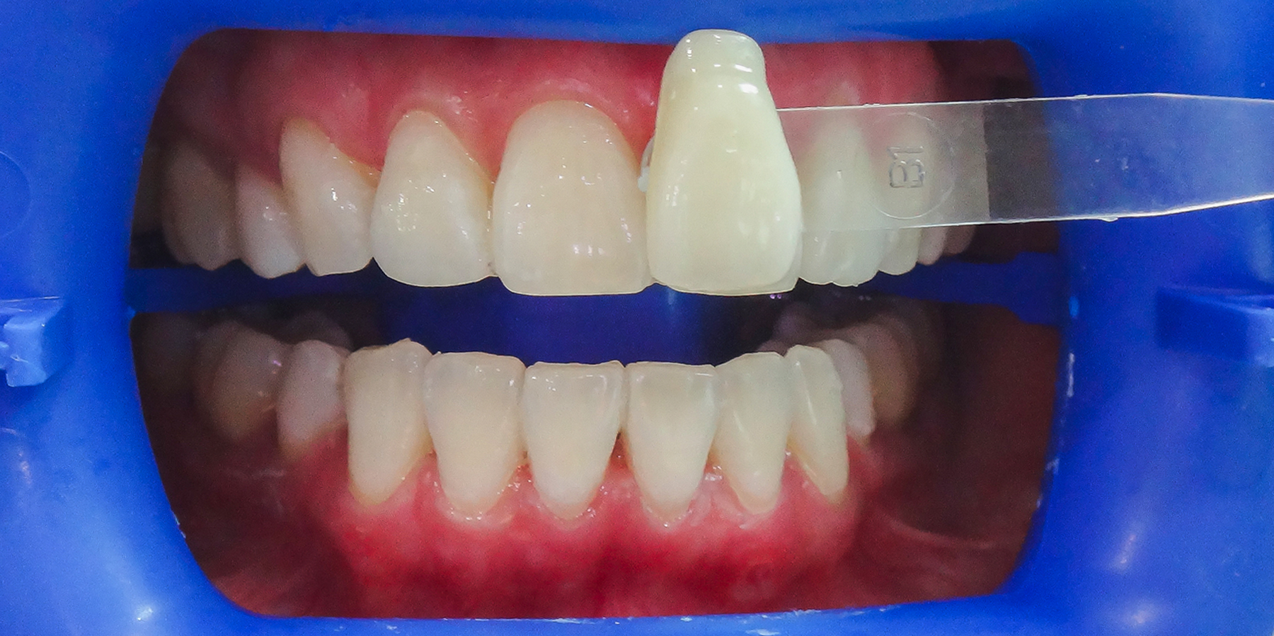 12-Laser-Teeth-whitening-after