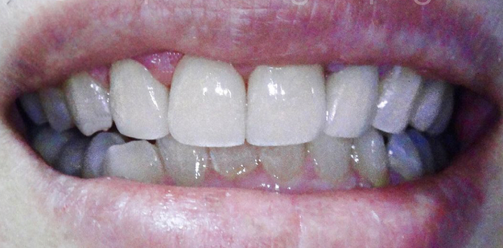 Dental-Crowns-After