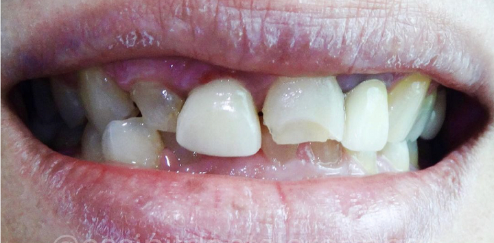 Dental-Crowns-Before