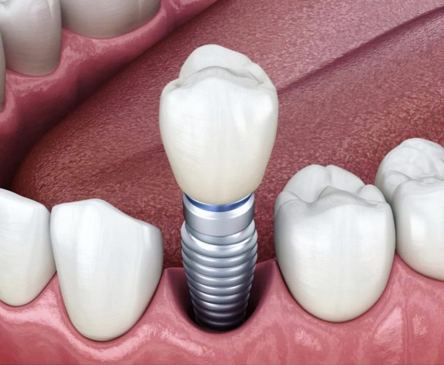 Dental-Implant-900x740