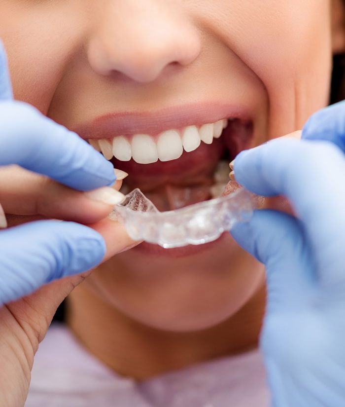 Invisalign-Treatment-700x825