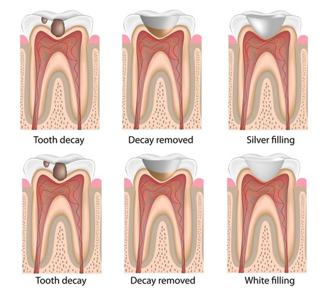 dental-filling-step-x-step-02