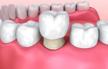 Dental Crowns