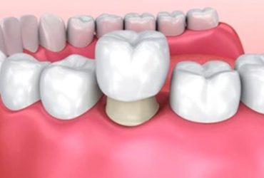 Dental Crowns