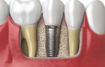 Dental Implant