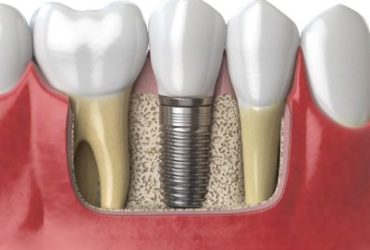 Dental Implant