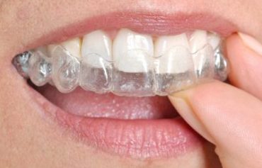 Invisalign