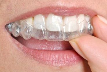 Invisalign