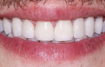 Porcelain  Veneers