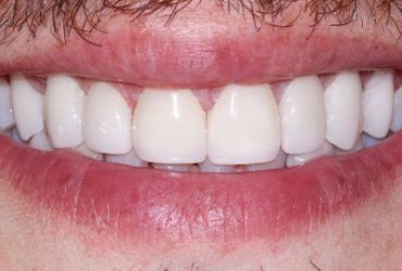 Porcelain  Veneers