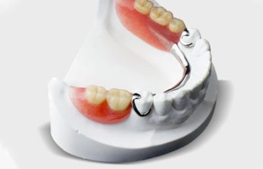 Removable Partial Dentures