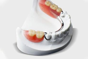 Removable Partial Dentures