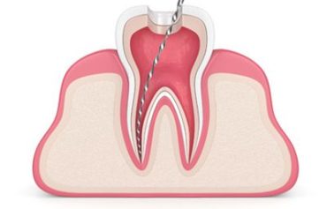 Root Canal Treatment