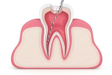 Root Canal Treatment