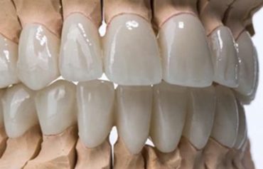 Zirconia Veneers