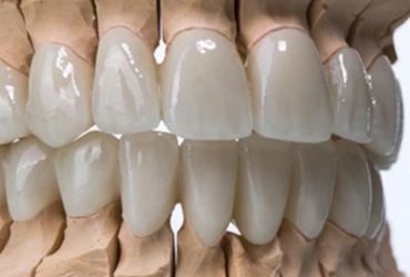 Zirconia Veneers