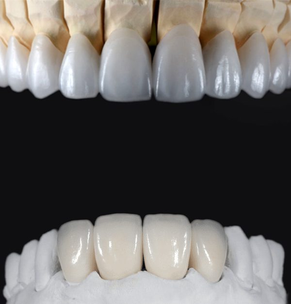 zirconia-veneers-600x626